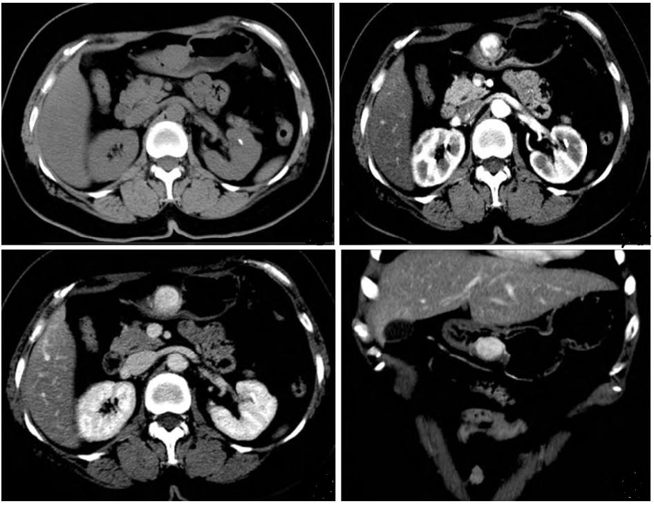 性结节样肿块,边缘光滑跨壁生长低密度肿块,密度均匀;多位于胃窦肌层