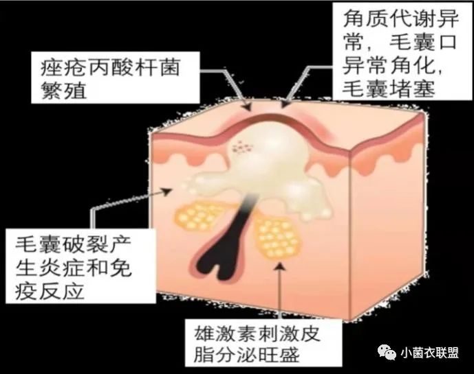 ①雄激素诱导的皮脂分泌过多②毛囊皮脂腺导管角化异常(堵塞③痤疮