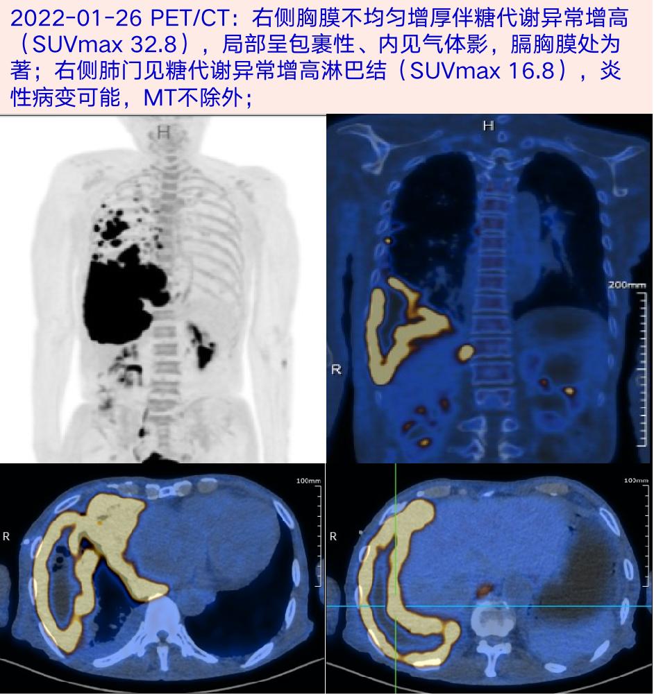 超聲造影引導下右側胸膜活檢,胸膜組織塗片找細菌真菌陰性,胸水細菌