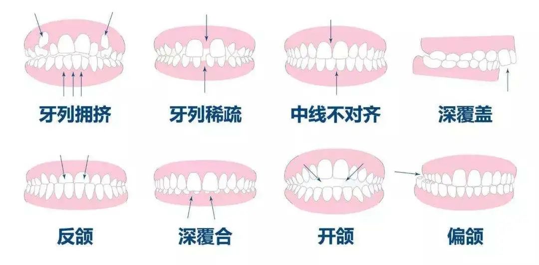 什麼是牙頜畸形