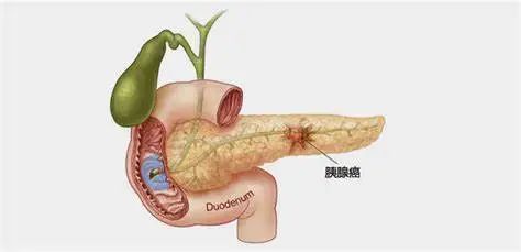 胰腺癌早诊筛查超声内镜作用大