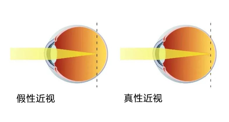 孩子近视涨得快其实用它就可以控制住