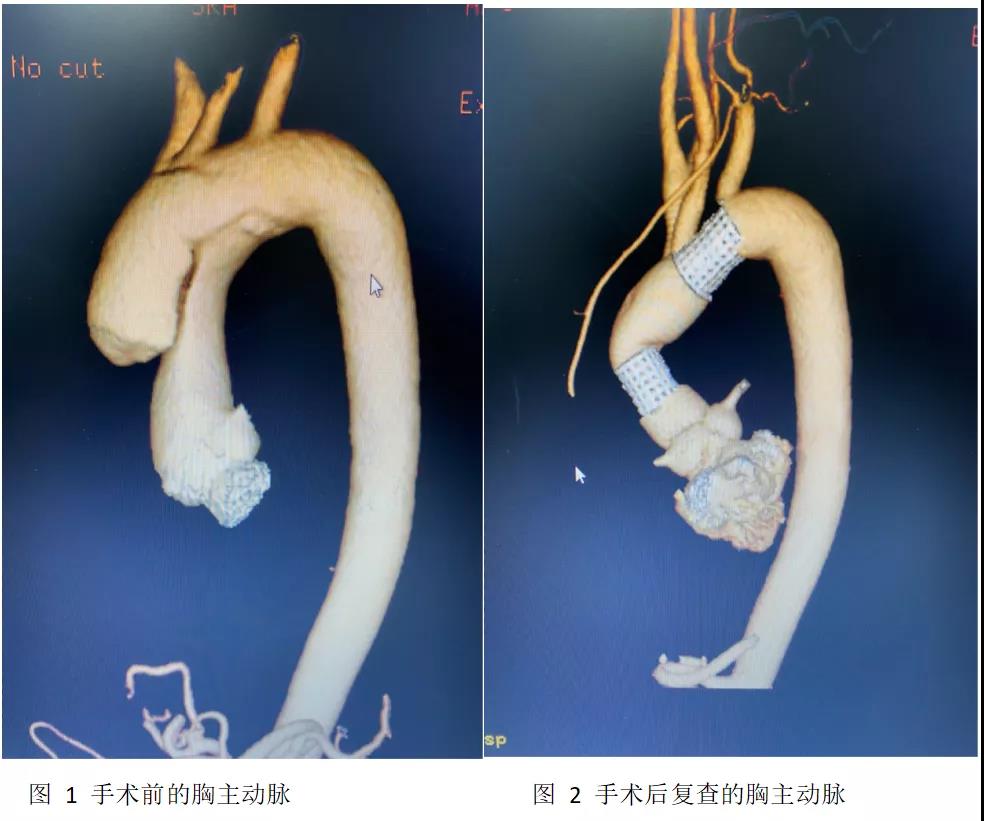 主动脉弓缩窄手术图片