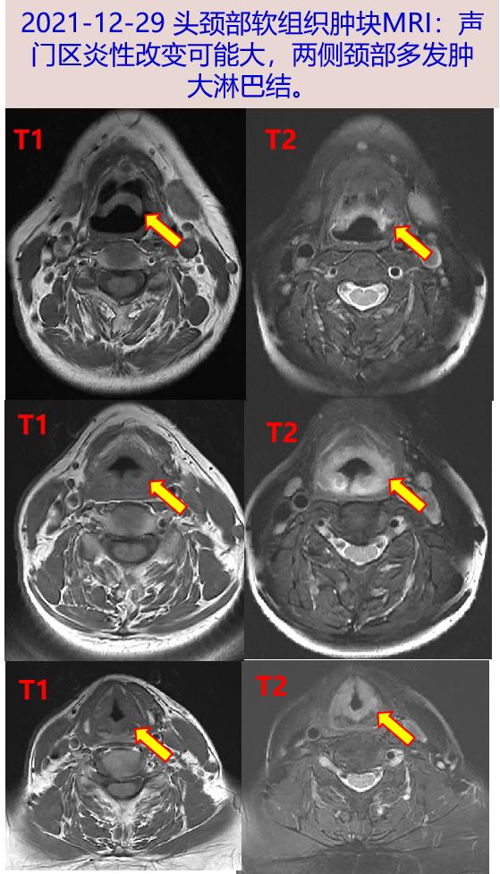 2021-12-29 头颈部软组织肿块mri:声门区炎性改变可能大,两侧颈部多发