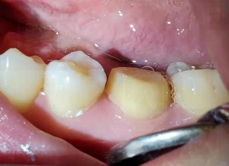 一篇推文改变一颗死髓牙的命运丨医患故事分享