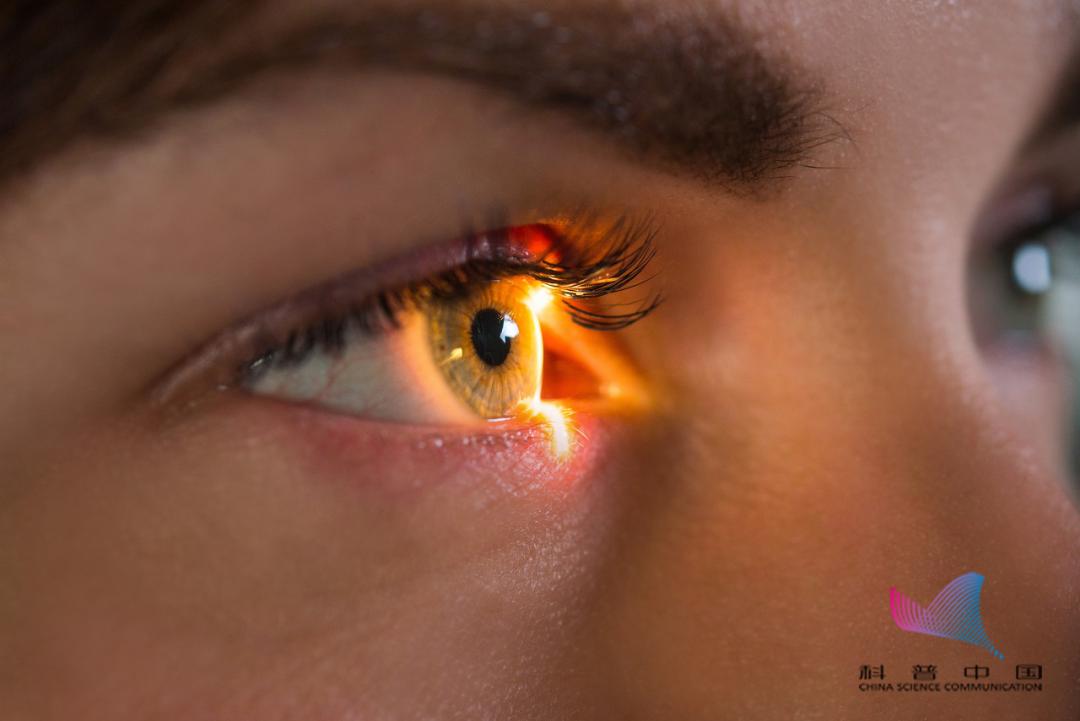 患者表现为眼痛,眼胀,眼红,视力下降,头痛,恶心呕吐,视物虹视等症状