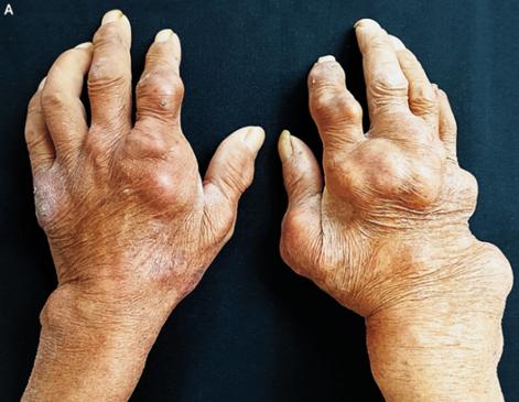 痛风石是什么?1,形成痛风石多系统损害你害怕吗?