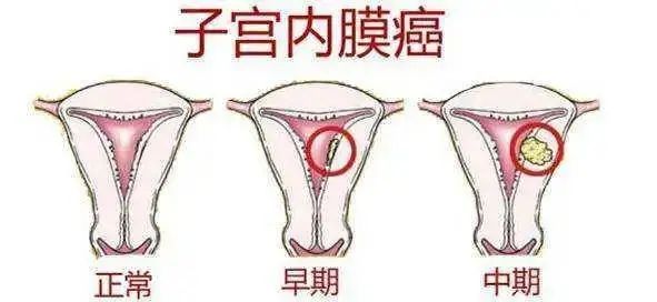 所有女性子宮內膜癌離你有多遠