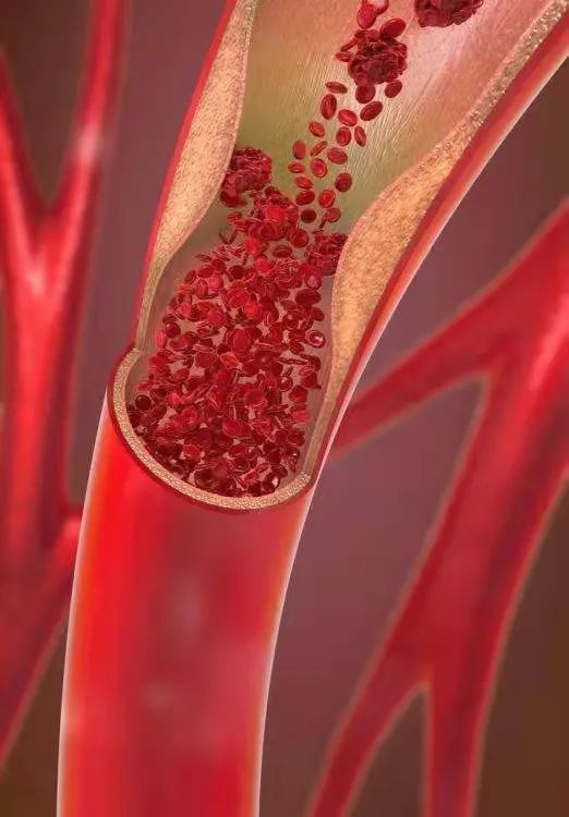 小安说产后沉默的杀手vte的预防及护理