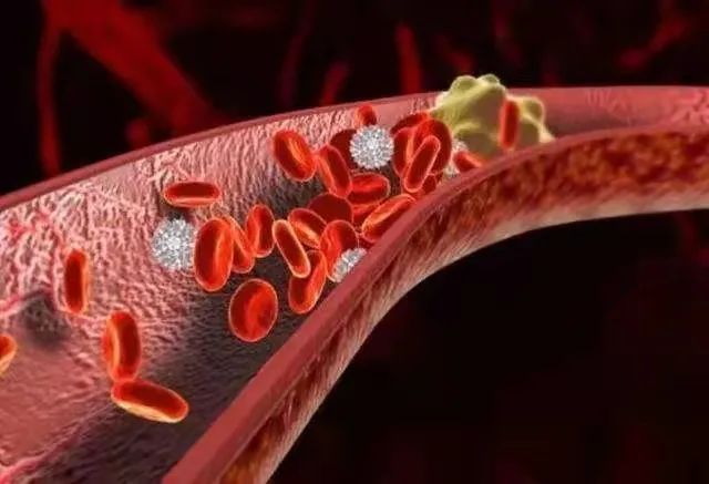 小安说产后沉默的杀手vte的预防及护理