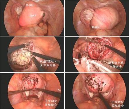 杨千嬅子宫切除图片