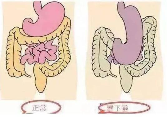 你还不知道饭后运动可能会导致胃下垂?