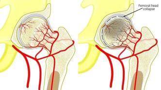 股骨頭壞死前的24小時……