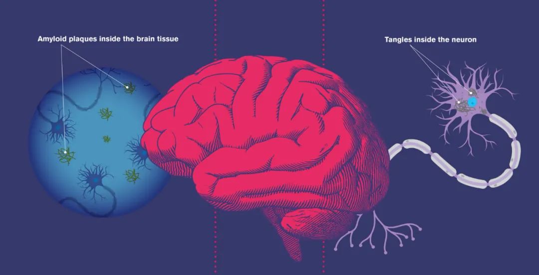 女性为何更易患阿尔茨海默病叶克强团队发现卵泡刺激素是关键