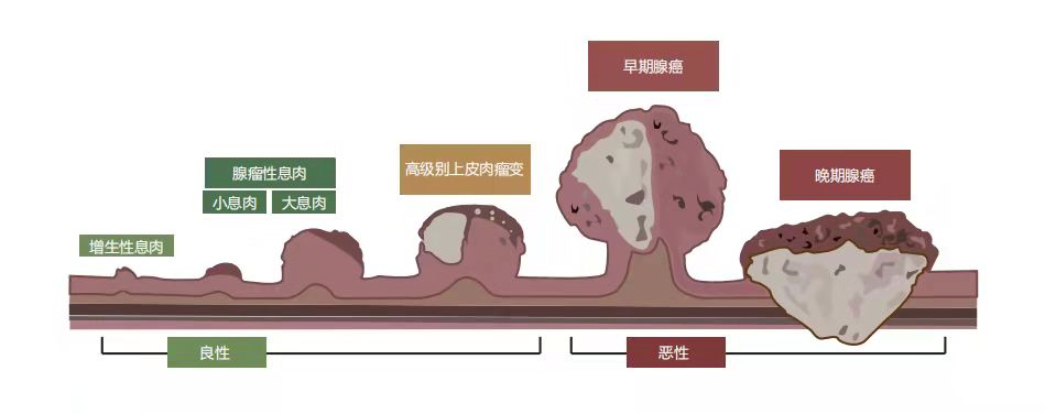 结肠息肉有癌变可能专家提醒这些人肠镜筛查不能省