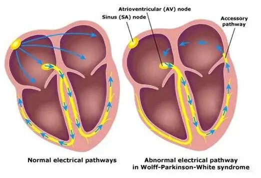 预激综合征——心脏不走寻常路