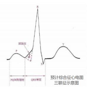 预激综合征——心脏不走寻常路