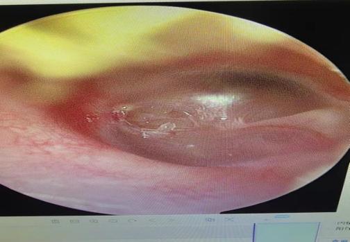 耳朵鼓室积液图片