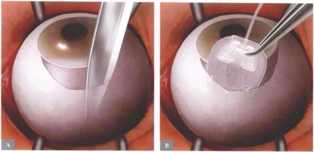 怎么装青光眼张宇燕：眼睛里装“阀门”，摆脱难治性青光眼困扰！_https://www.jmylbn.com_新闻资讯_第2张