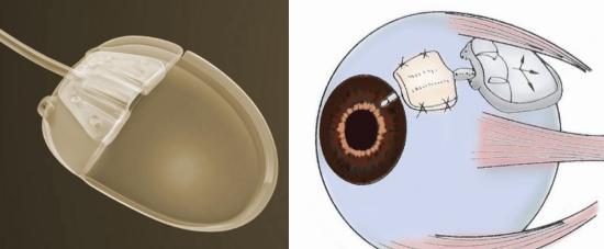 怎么装青光眼张宇燕：眼睛里装“阀门”，摆脱难治性青光眼困扰！_https://www.jmylbn.com_新闻资讯_第3张