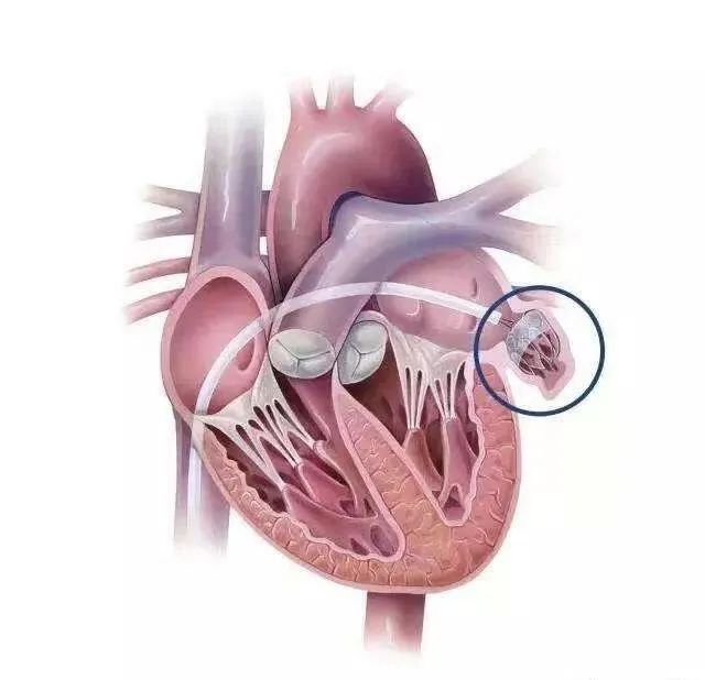 射频消融左心耳封堵术后造影房颤持续发作可导致心脏结构发生改变