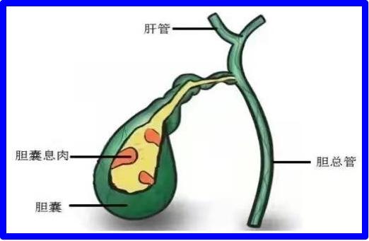 金小鸥讲健康胆囊息肉样病变胆囊癌