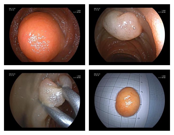 六院新闻攻坚克难精准新技术微创切除空肠巨大脂肪瘤