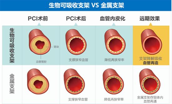 我院心內科成功完成首例血管內超聲指導下生物可吸收支架植入術