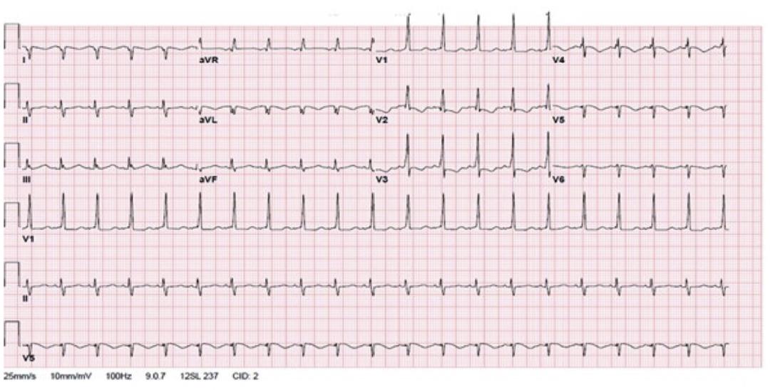 6ng/ml;心电图可见i,avl导联呈qs型(见图1),提示左室侧壁心肌梗死.
