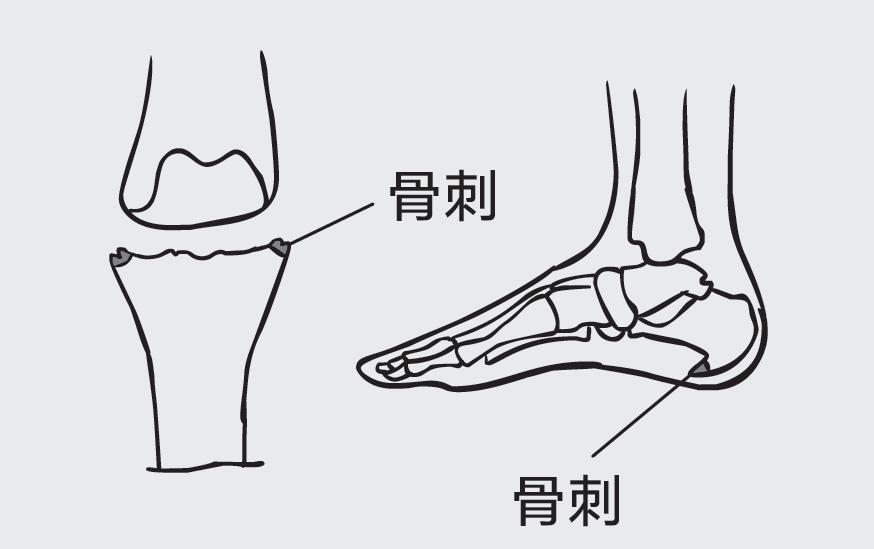 如何才能把骨刺消掉