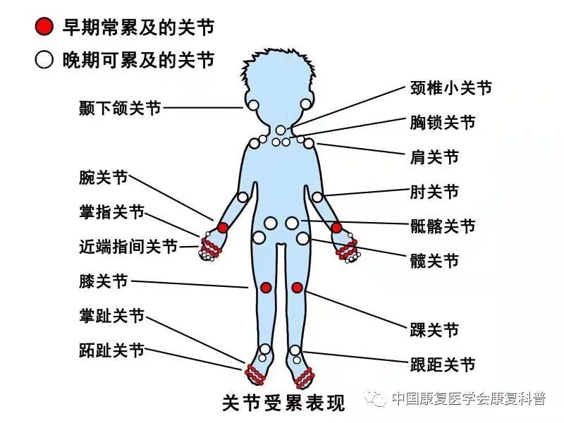 疫情期间类风湿性关节炎患者居家康复方案