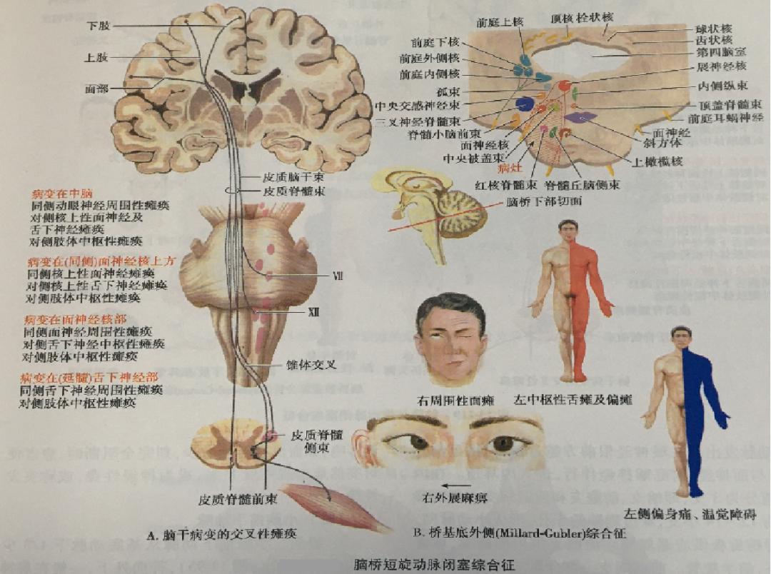 腦血管解剖之腦橋穿支動脈一文掌握