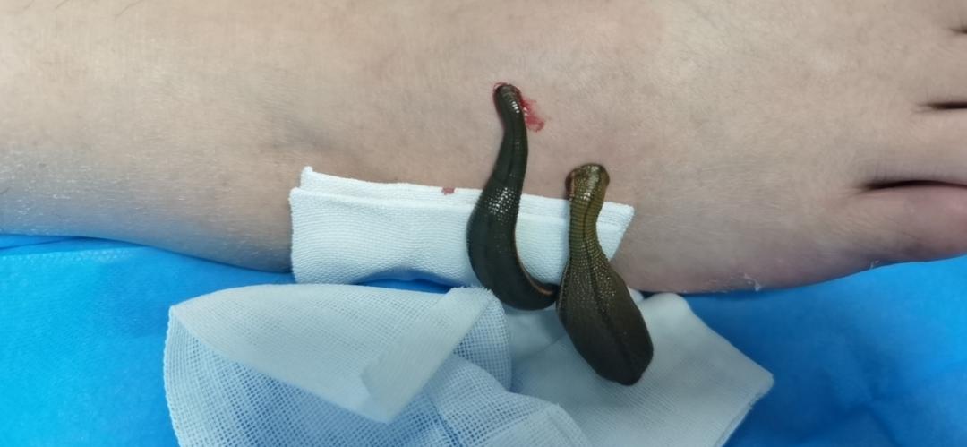 开创先河田里咬人的蚂蟥竟还能这样用