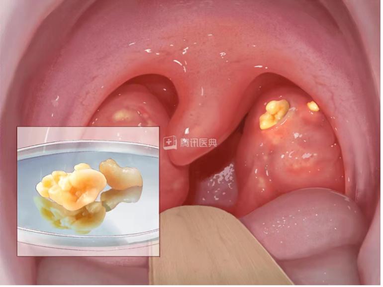 自行挤出唾液腺结石图片