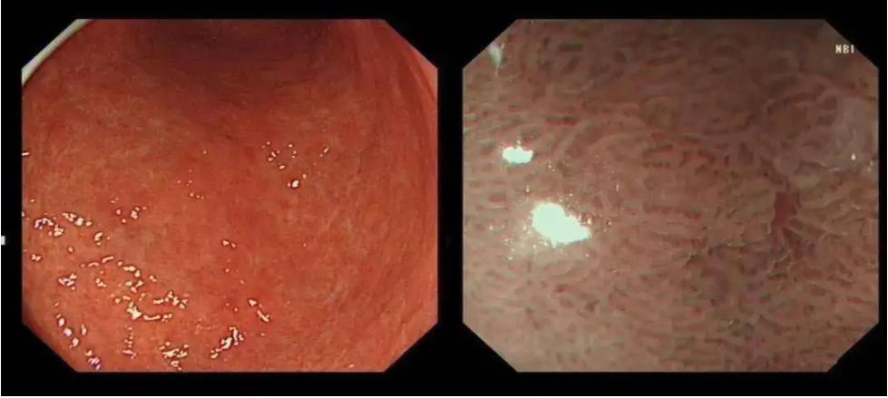 慢性萎缩性胃炎胃镜图图片