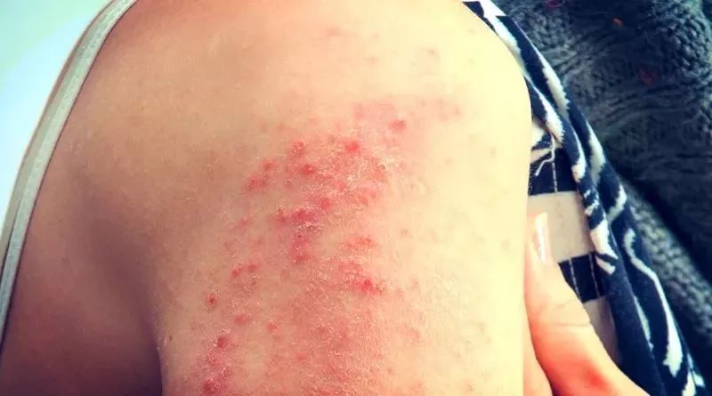 皮肤好痒啊越挠越痒到底是怎么回事