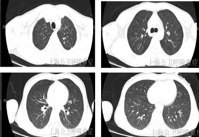 結核桿菌悄悄跑進大腦看兩位主任如何診治