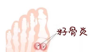 籽骨炎并没有明显的瘀伤或发红(偶尔发炎时也会引起轻度发热和肿胀或