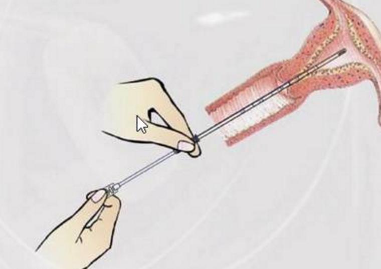 以下情况可以改行宫腔镜手术:保守治疗时间长,残留物持续存在.