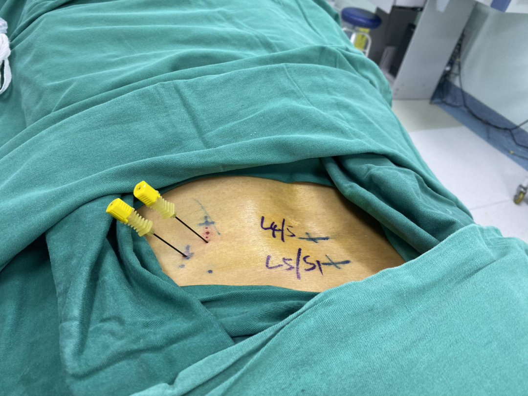 腰椎间盘突出症的诊疗,科室逐渐形成了一套具有自身特色的阶梯式治疗