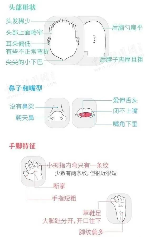 即21-三体综合征,又称先天愚型或down综合征,是由染色体异常(多了一条