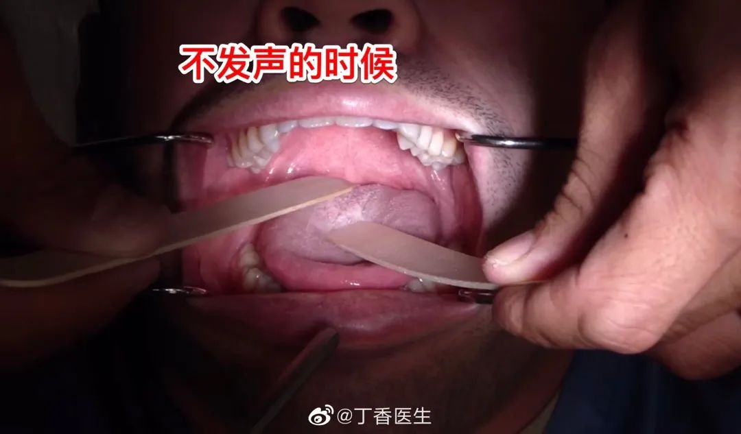 核酸检测伸舌头图片