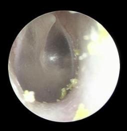 耳膜上有白色异物膜图图片