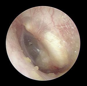 外耳道胆脂瘤症状图片图片
