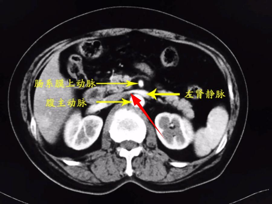 图2:胡桃夹综合征患者ct检查呈明显的"鸟嘴征"若上述检查仍不能确诊