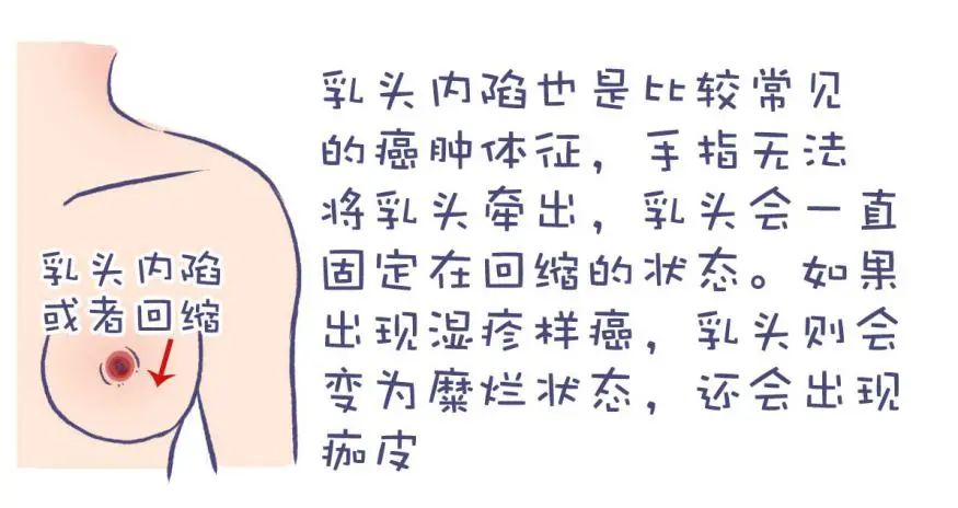 乳房反覆溼疹,竟確診乳腺癌,