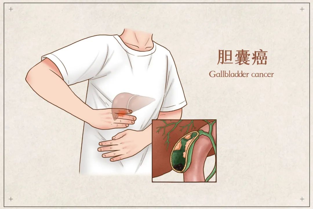 胆囊炎会不会变成癌胆囊癌的高危因素有哪些