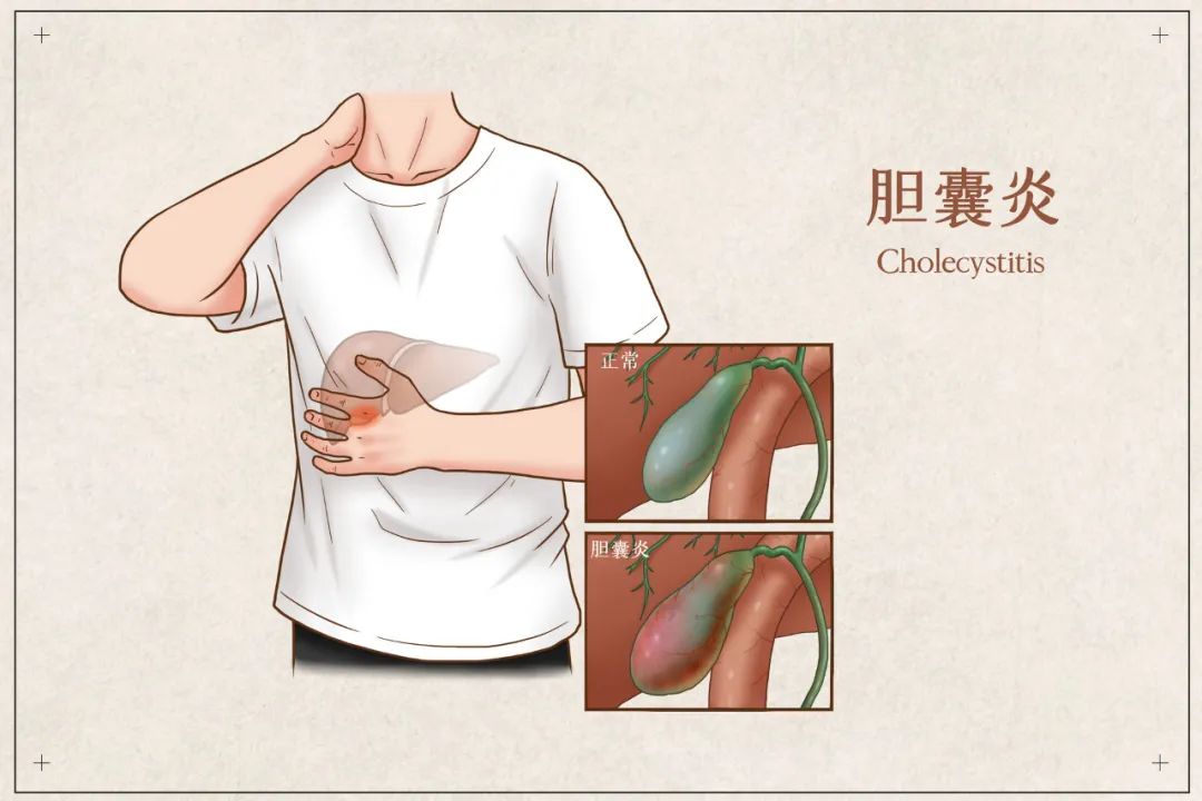 胆囊炎会不会变成癌胆囊癌的高危因素有哪些