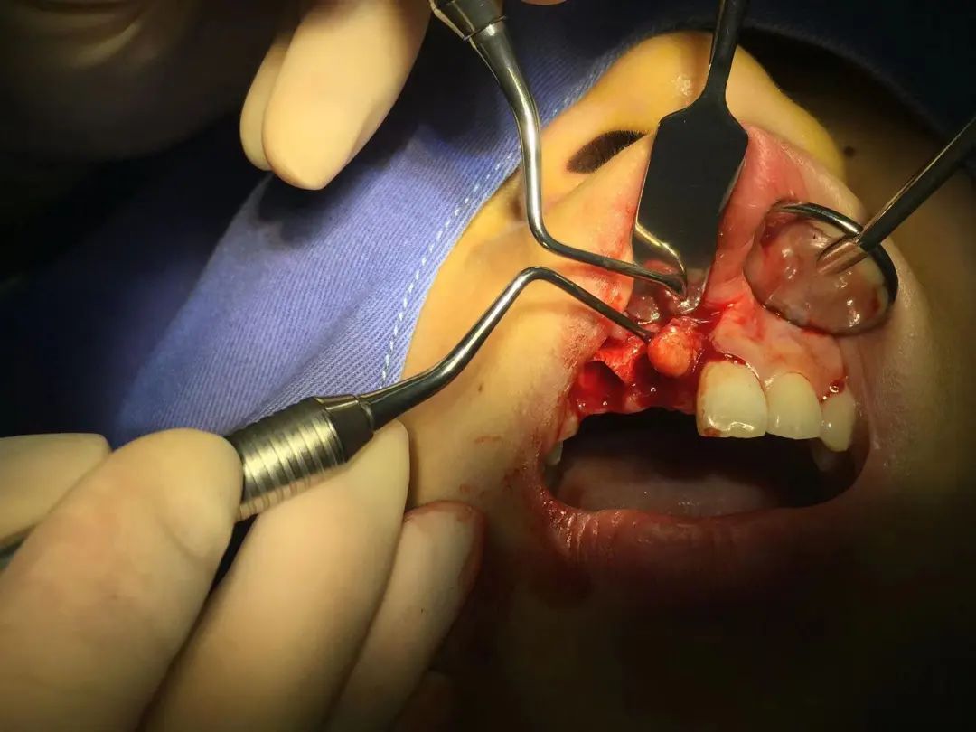 嘎嘣我寻思这口干脆面可真脆一舔发现是牙崩了