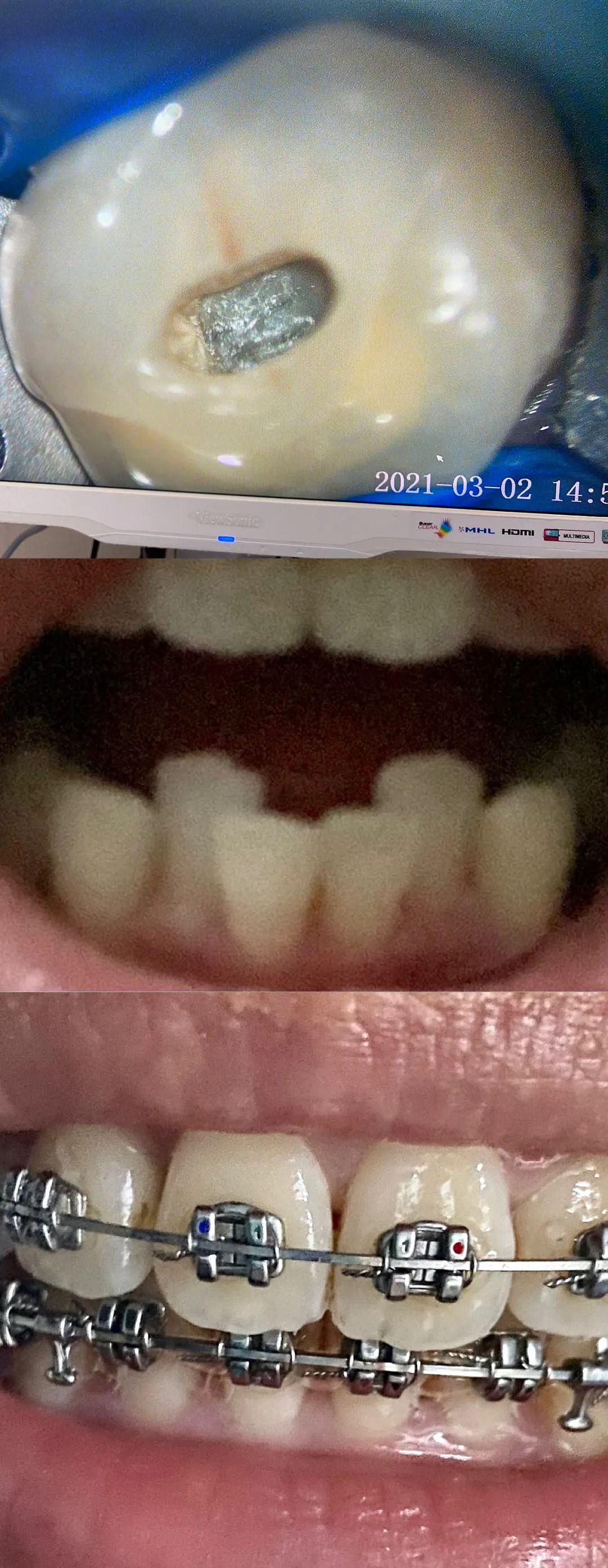 嘎嘣我寻思这口干脆面可真脆一舔发现是牙崩了